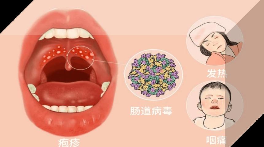 【健康科普】孩子高烧还喉咙长满疱疹？疱疹性咽峡炎正在流行中